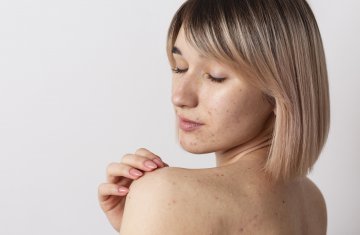 Акне – болезнь XXI века: почему на коже появляются высыпания
