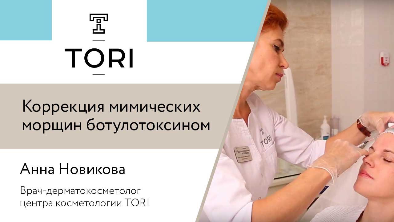 Анна Новикова. Коррекция мимических морщин ботулотоксином