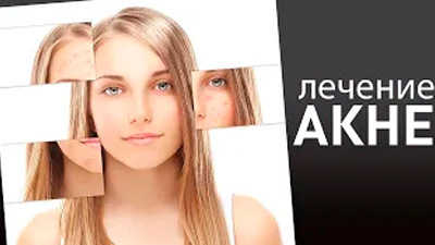 ЛЕЧЕНИЕ АКНЕ