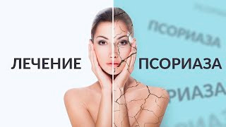 ЛЕЧЕНИЕ ПСОРИАЗА