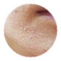 Лазерофорез гиалуроновой кислоты кожи лица