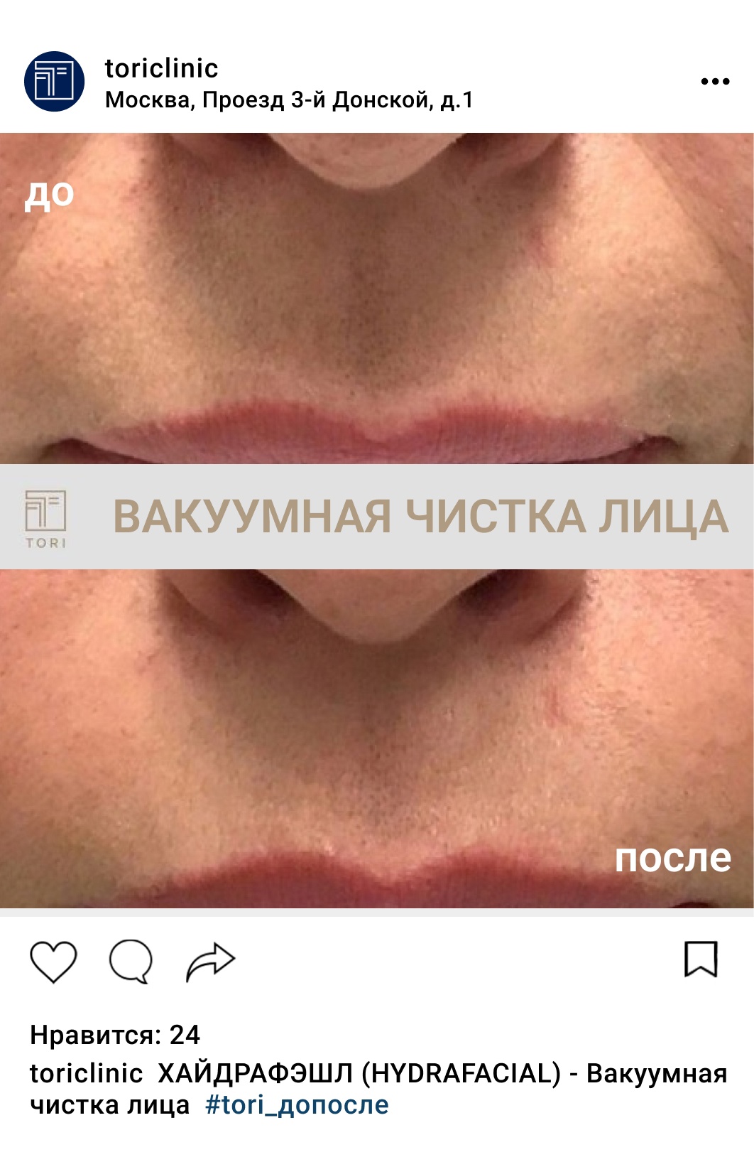 Вакуумная чистка лица (гидропилинг) HYDRAFACIAL (ХАЙДРАФЭШЛ): цена  процедуры в Москве