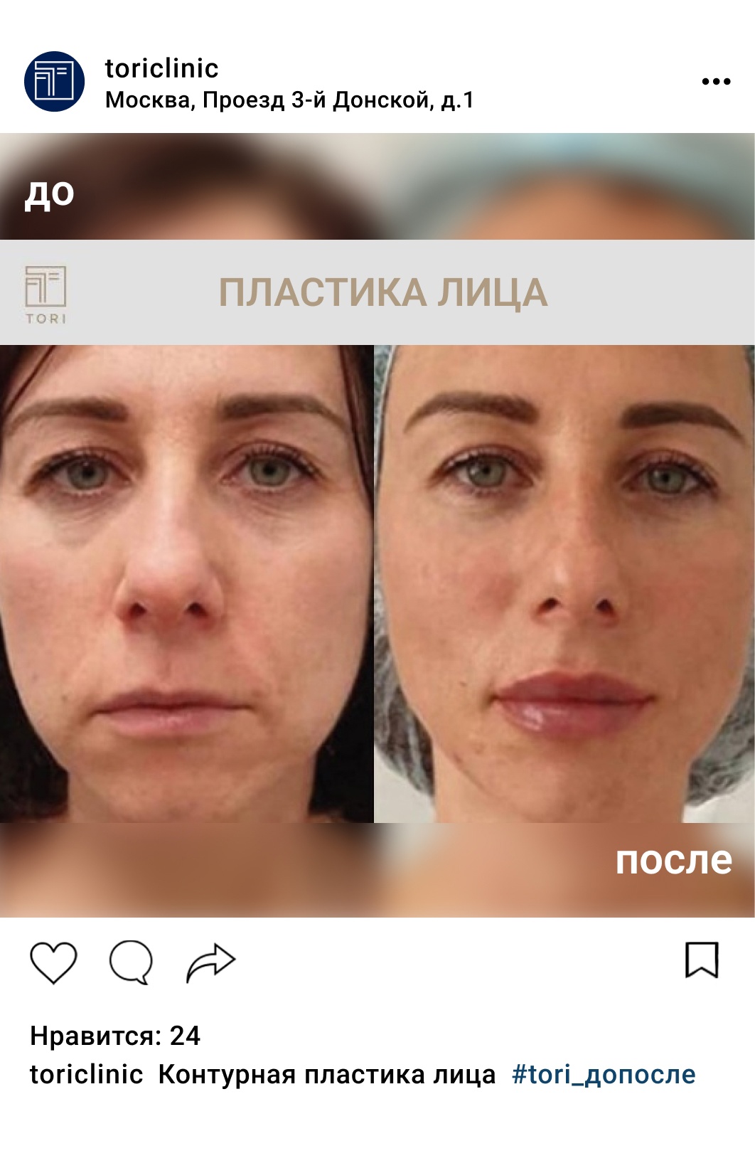гиалуронка для лица до и после фото
