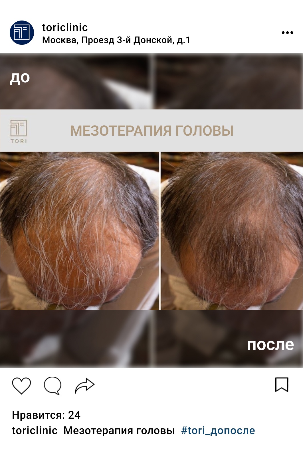 Мезотерапия волос и кожи головы