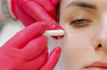 Нитевой лифтинг: преимущества и недостатки